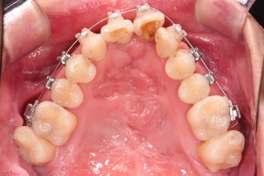 부산구순구개열교정