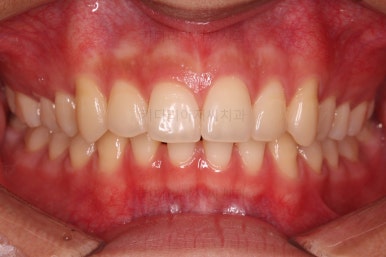 부산연산동치아교정