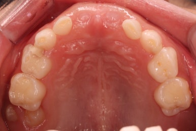 부산어린이치아교정