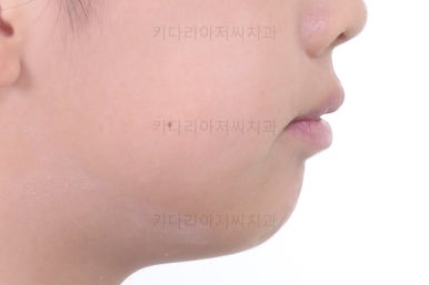 부산토끼치아교정
