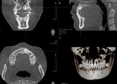 부산매복치아교정