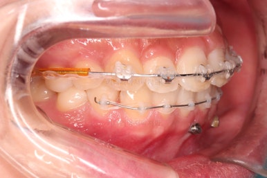 부산앞니부분교정