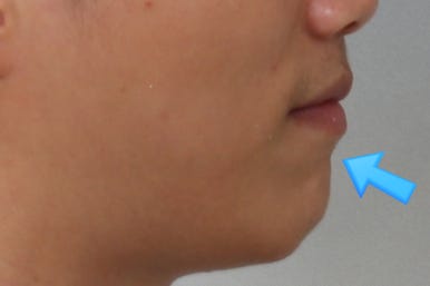 부산왜소치교정