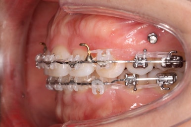 부산연산동교정치과
