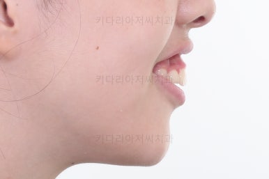 부산투명교정