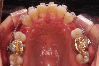 동래임플란트교정