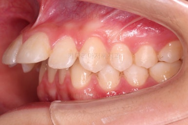 연산동치아교정