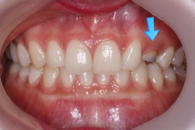 부산매복치아교정