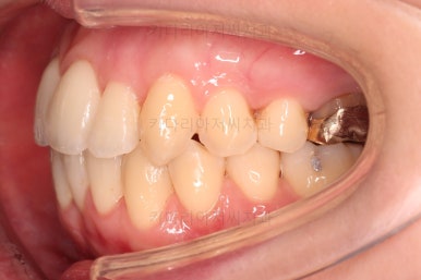 부산치아교정잘하는곳