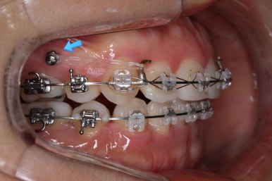 부산연산동교정치과