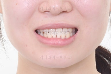 부산치아교정추천