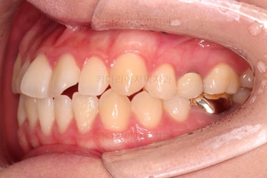 부산치아교정잘하는곳