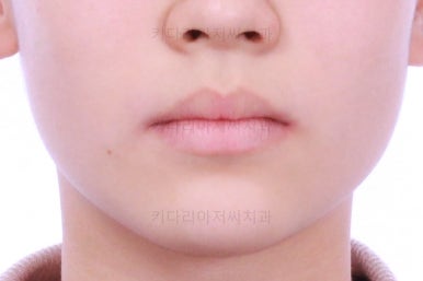 부산연산동치아교정