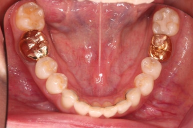 부산치아교정비용