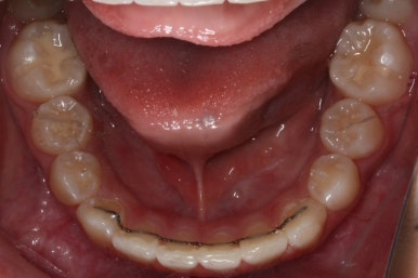 연산동덧니교정