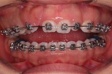 부산구순구개열