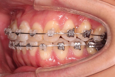 연산동치아교정