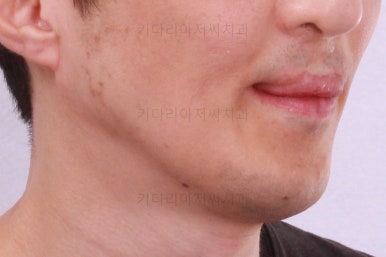 부산구순구개열교정