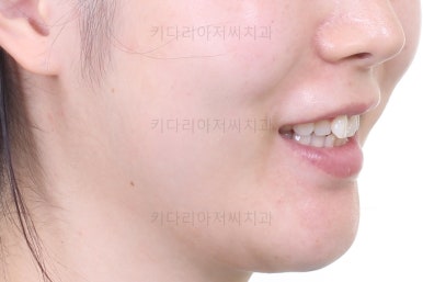 부산부분치아교정