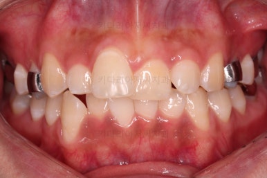 부산안면비대칭