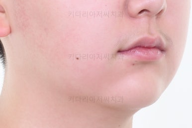 부산치아교정