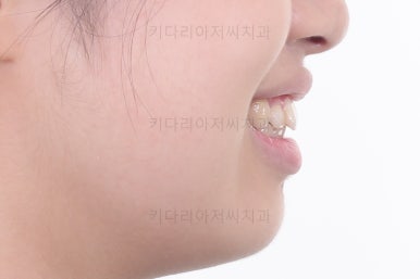 부산치아교정