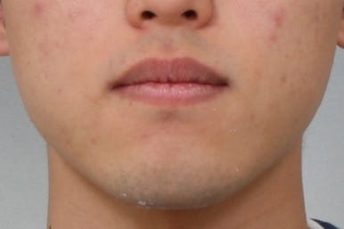 부산주걱턱교정