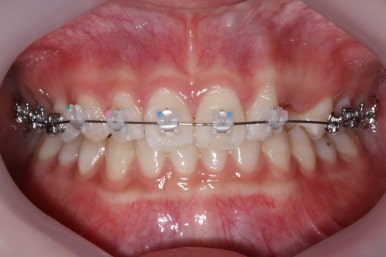 부산매복치아교정