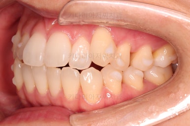 부산인비절라인