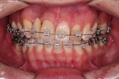 연산동치아교정