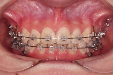 연산동치아교정