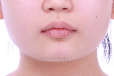 부산어린이치아교정