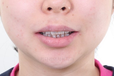 부산연산동교정치과