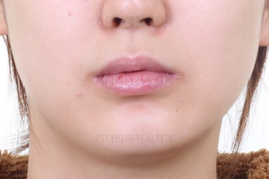 부산안면비대칭