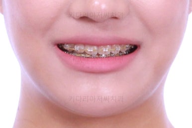 연산동치아교정치과