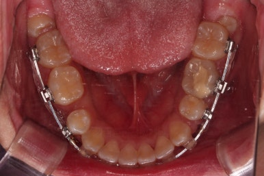 부산청소년치아교정