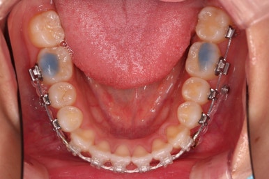 부산비발치교정