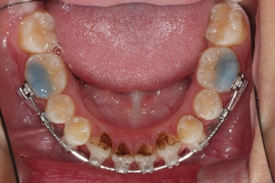 연산동치아교정