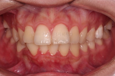 부산클리피씨교정