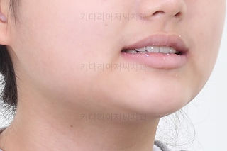 연산동치아교정