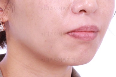 부산연산동교정치과