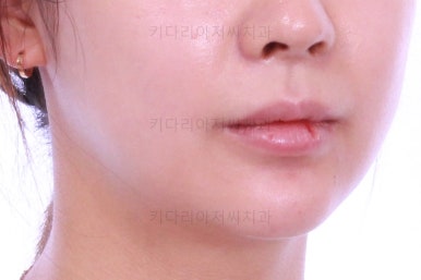 부산안면비대칭