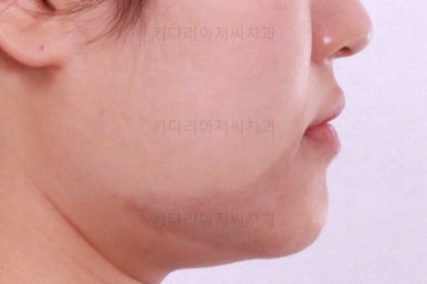 부산치아교정잘하는곳