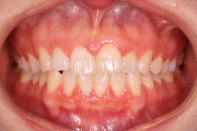 부산나비앞니교정