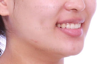 부산치아교정