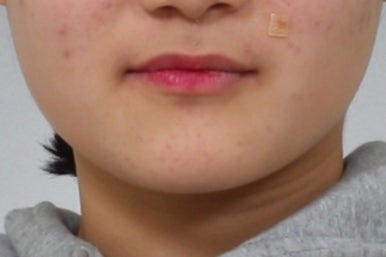 부산매복치아교정