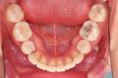 부산치아교정잘하는치과