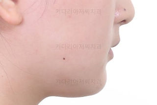 부산옥니교정