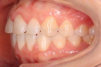 부산나비앞니교정