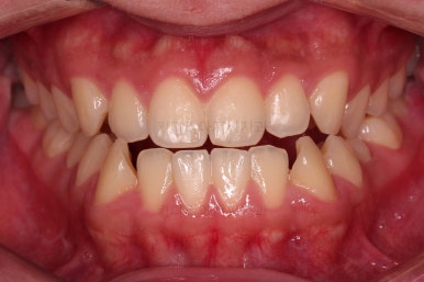 부산주걱턱교정